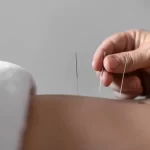 mão segurando agulha de acupuntura