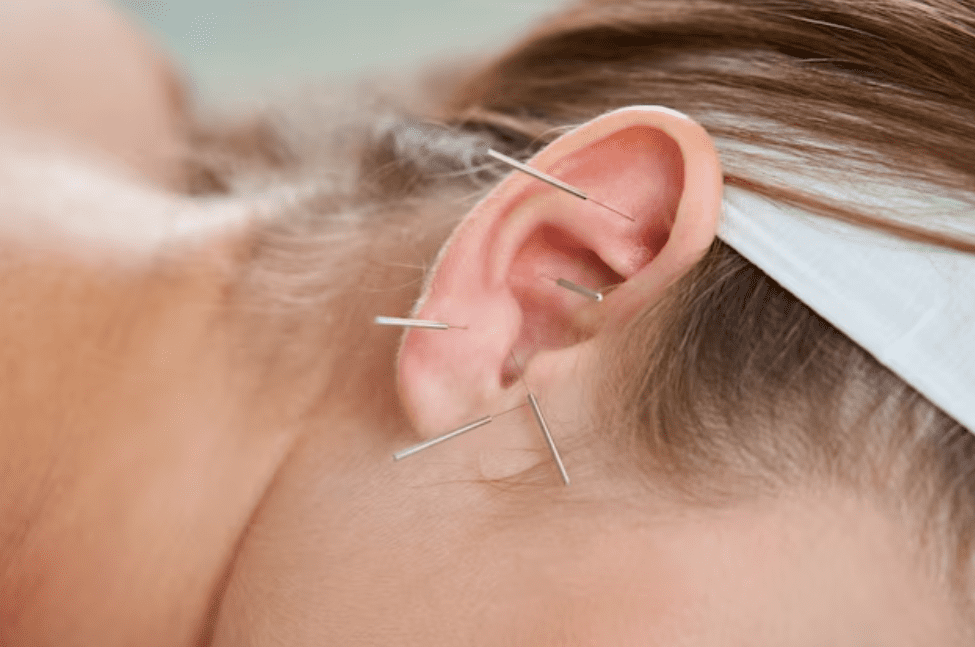 Acupuntura