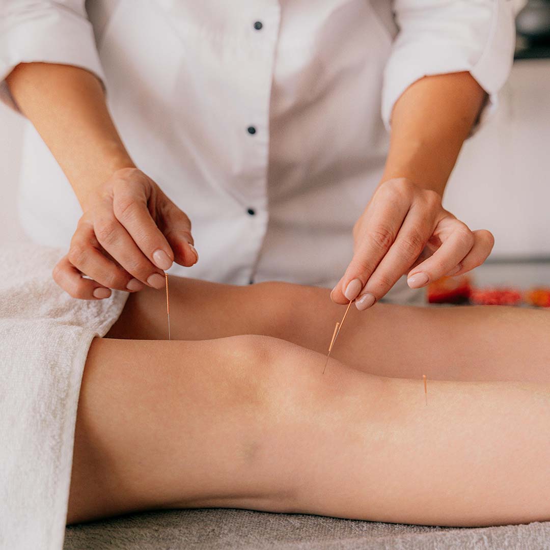 Acupuntura sendo aplicada em dor crônica no joelho